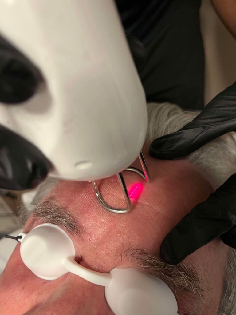 Behandling med laser på huden