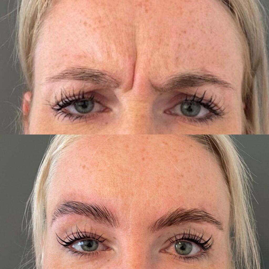 Botox